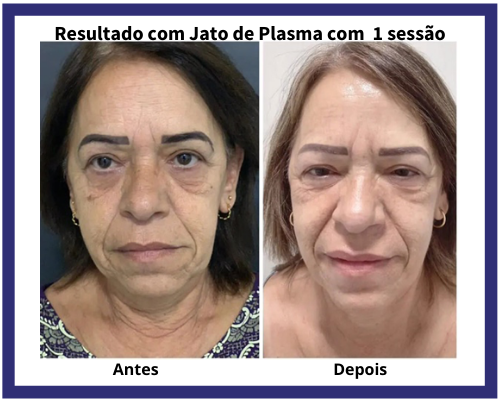 resultado jato de plasma