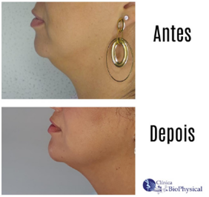 Harmonização Facial