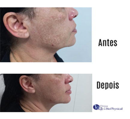 Harmonização Facial